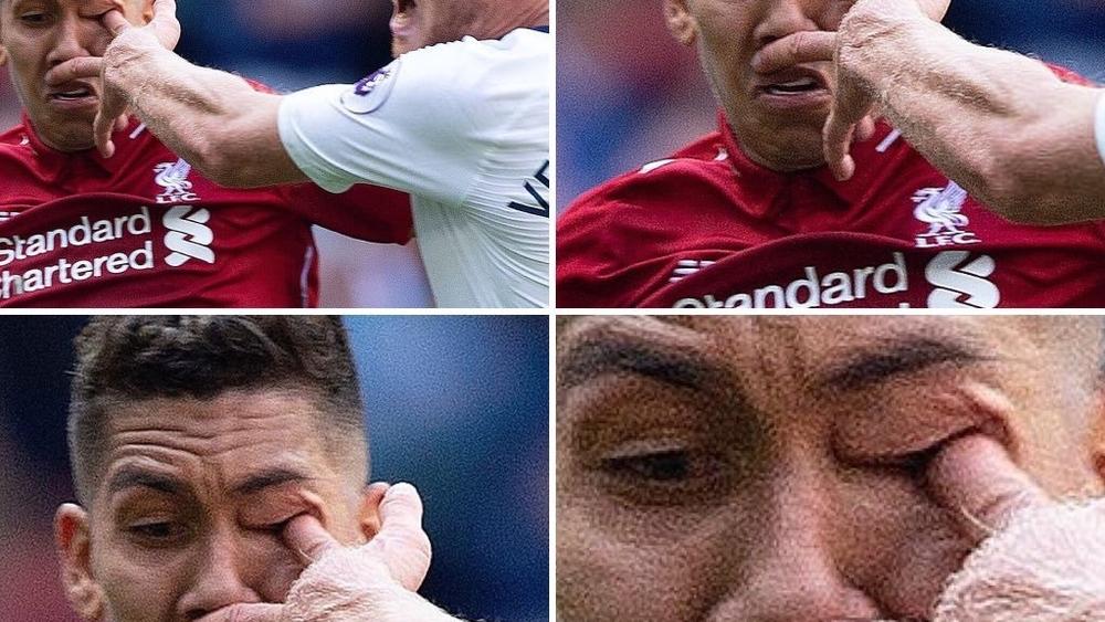 بالصورة | إصابة بشعة لفيرمينيو ضد توتنهام