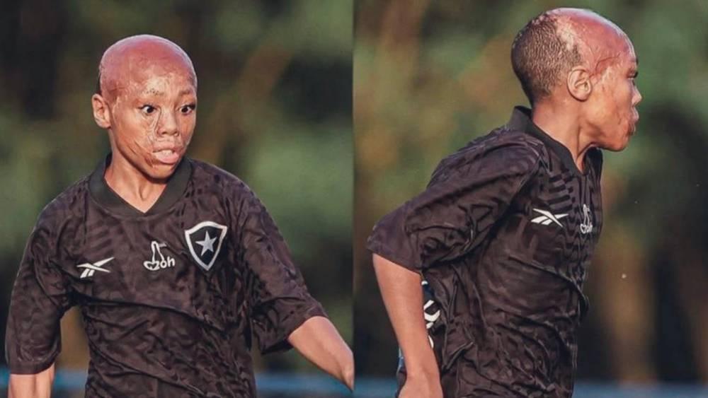 الطفل برناردو لوبيز (11 سنة).. نجا من الموت وحقق حلم لعب كرة القدم بالالتحاق بأكاديمية بوتافوغو